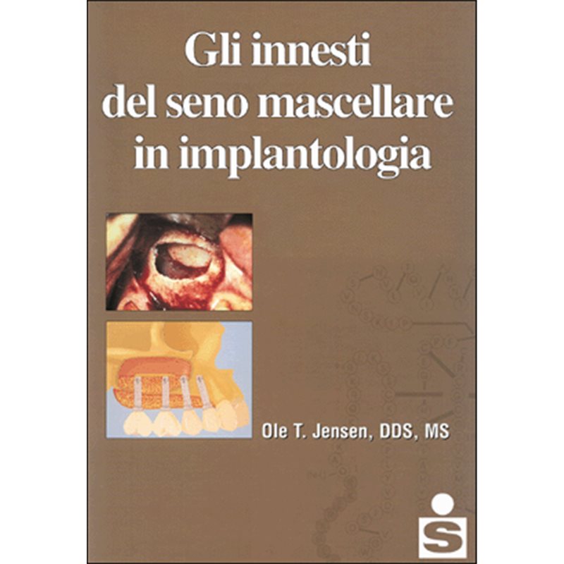 Gli innesti del seno mascellare in implantologia